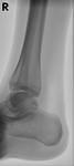 X-rays images of my right ankle